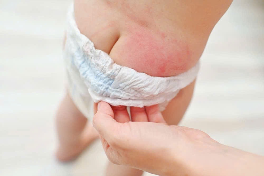dấu hiệu trẻ bị hăm